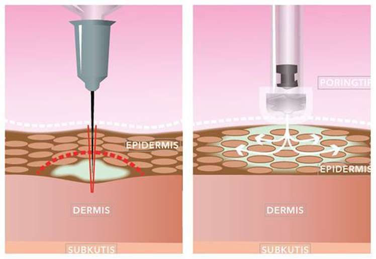 Hydroporation®